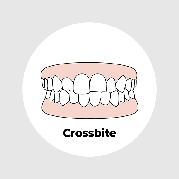 Crossbite