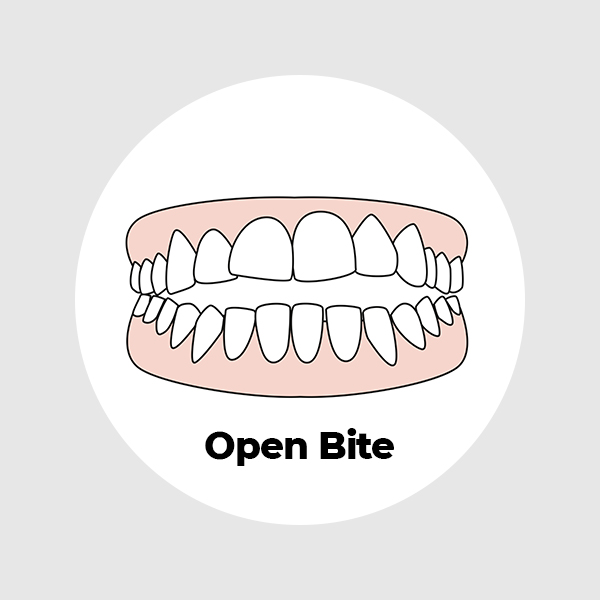 open-bite