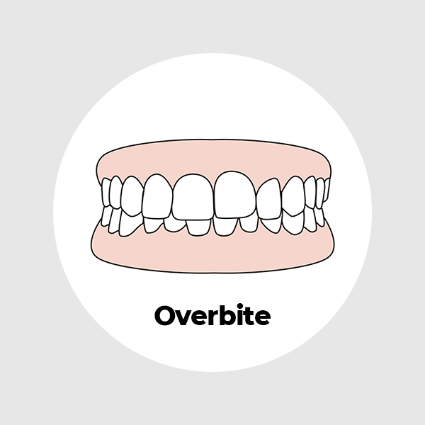 overbite