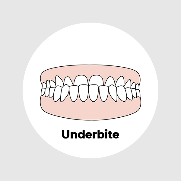 underbite