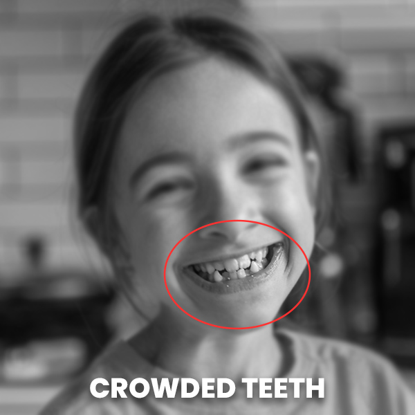 Crowded Teeth