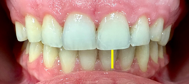 after insmile braces