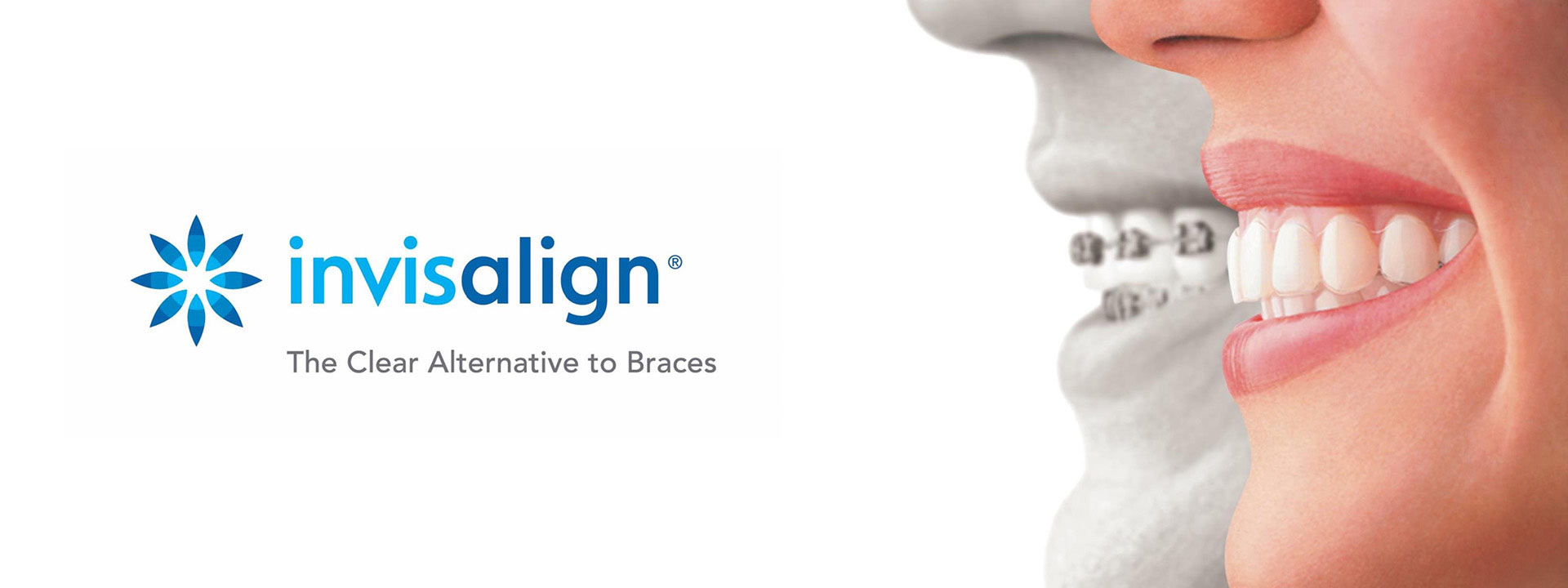 Invisalign for Minor Underbites