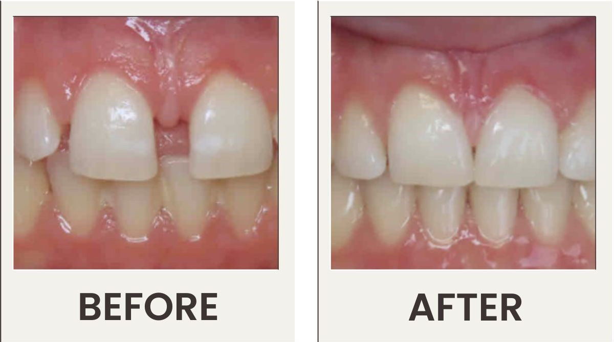 InSmile Braces Patient InSmile Braces Patient