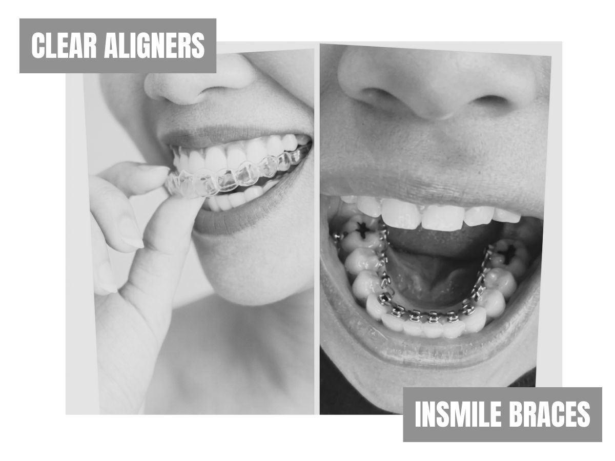 Behind the teeth (1) clear aligners vs insmile braces