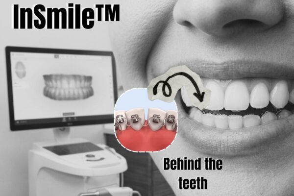 Orthodontics in NoMad: Expert InSmile™ Treatment for Busy Professionals