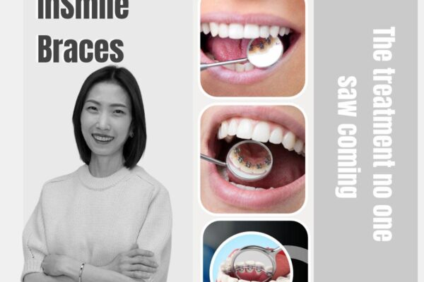 Hidden Lingual braces in NoMad