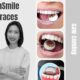 Behind-the-teeth-insmile-braces