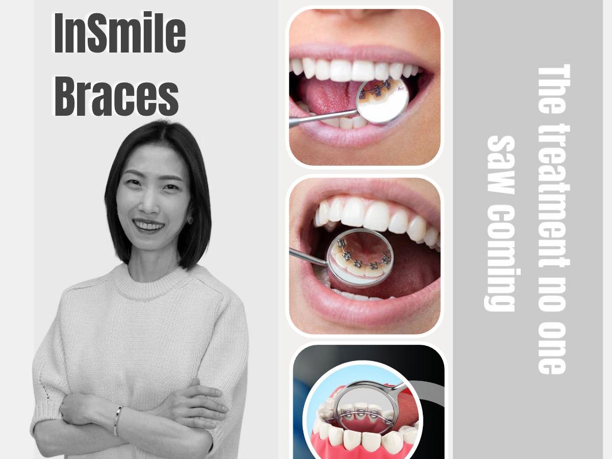 Behind-the-teeth-insmile-braces